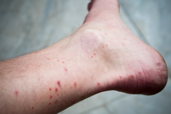 How to Remove Dark Spots on Legs from Mosquito Bites