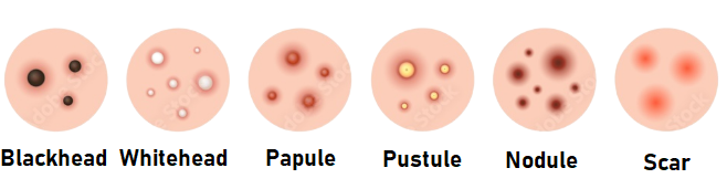 Types of Pimples