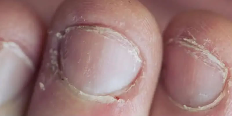 How to Treat Peeling Cuticles