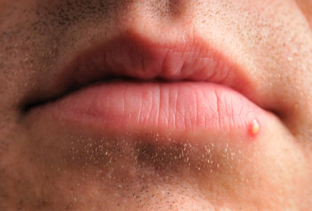 How To Get Rid Of Lip Pimples for Good – The Ultimate Guide