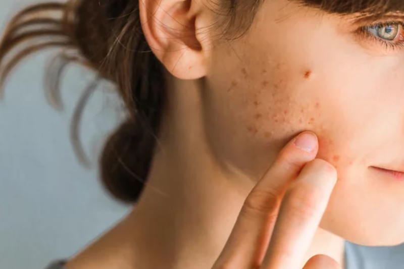 How To Get Rid Of Blood Pimples for Good – The Ultimate Guide