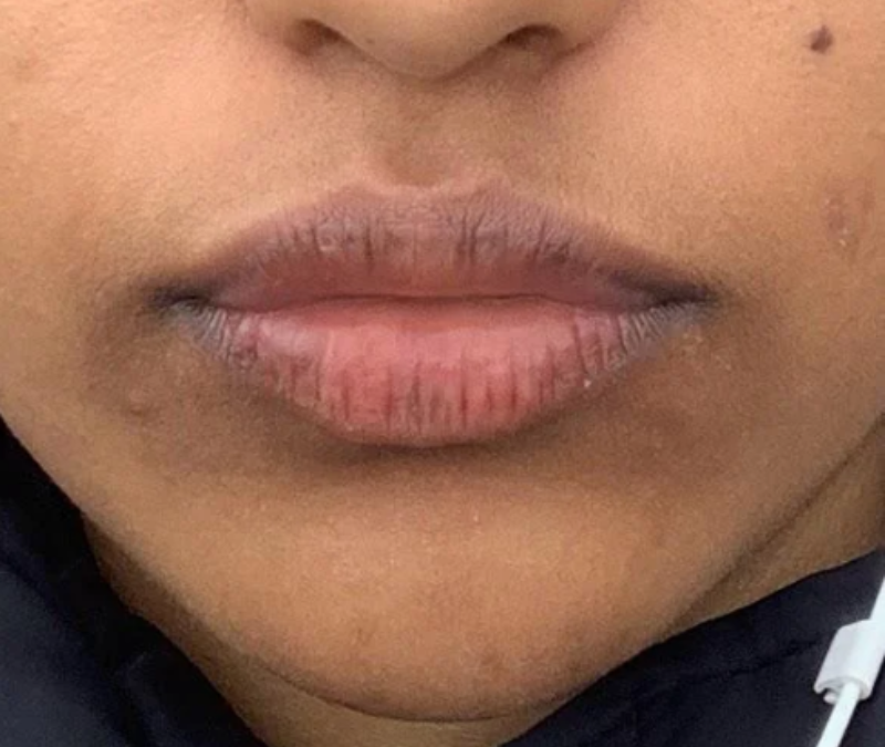 Everything You Need to Know About Hyperpigmentation Around Mouth