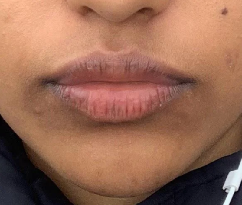 Hyperpigmentation Around Mouth