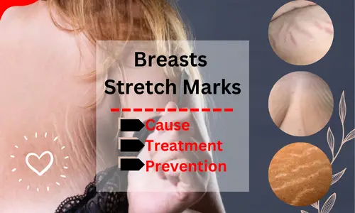 How To Get Rid Of Stretch Marks On Breasts Quickly and Easily