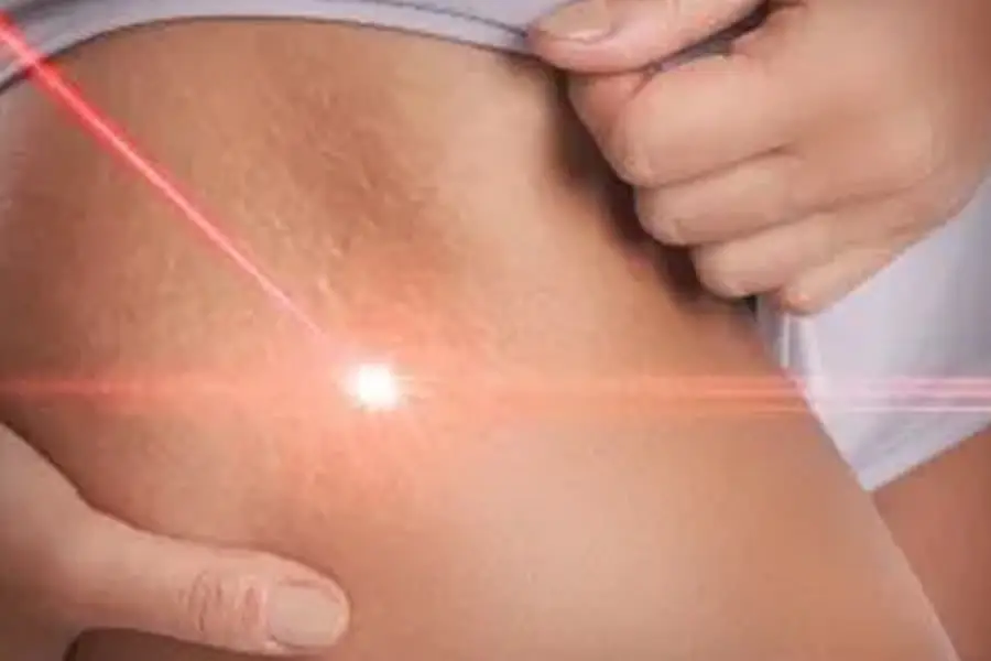 Laser-Light-Benefits