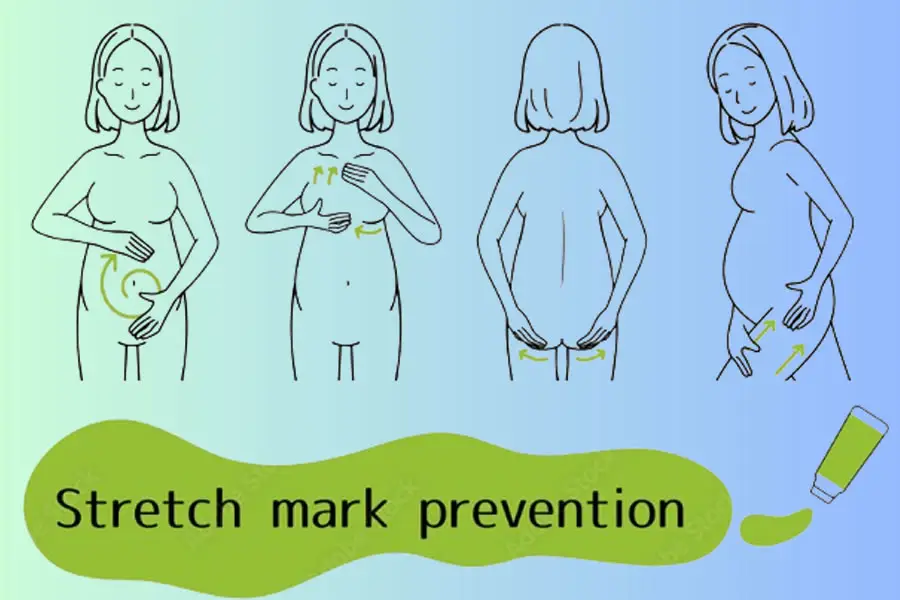 Stretch-marks-Prevention